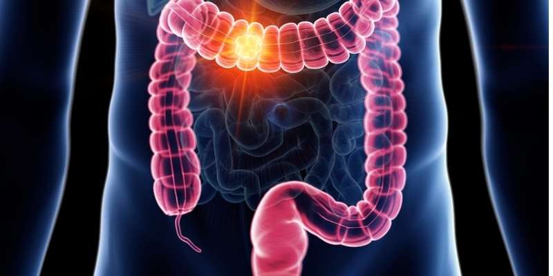 rektum-kanseri-tedavisi